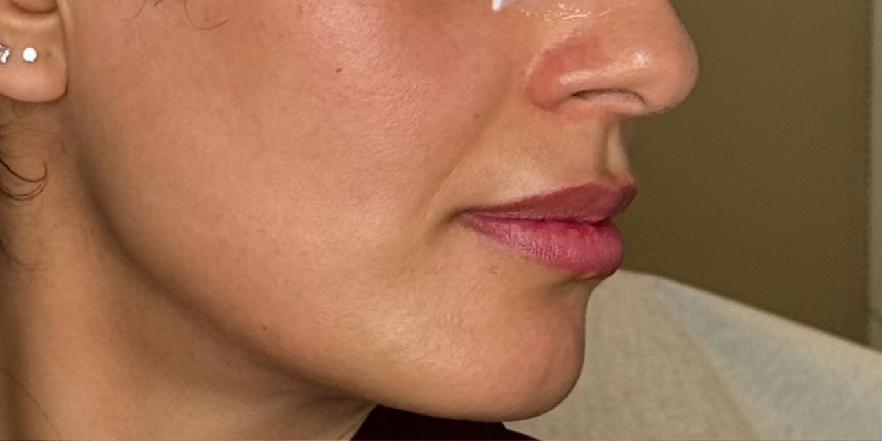 Before treatment